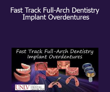 Fast Track Full-Arch Dentistry Implant Overdentures